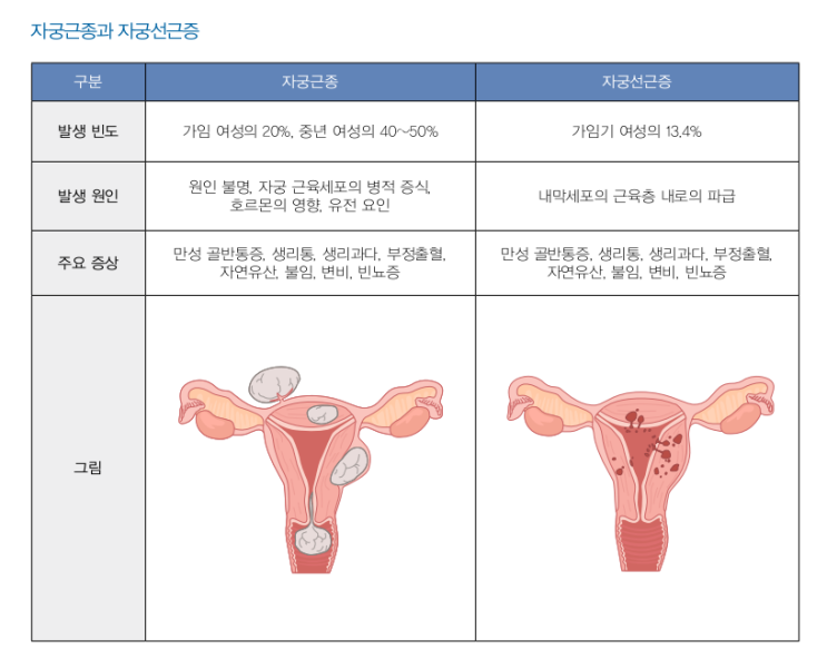 자궁근종, 자궁선근증, 자궁적출에 대한 내용들