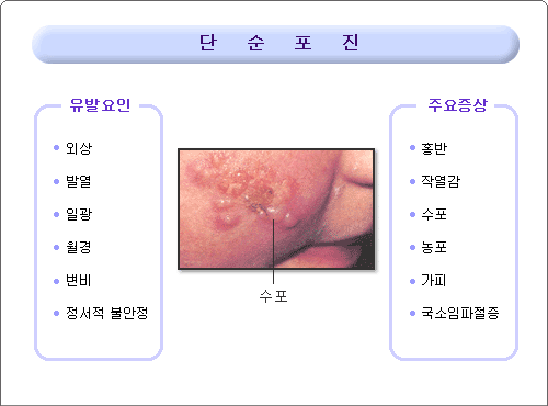 성기포진 헤르페스바이러스 머터니티 헤르페스주의