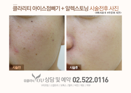 클라리소닉 여드름 흉터 전후