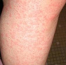 한랭성 두드러기 증상 추운날 소양증이 심하면 5