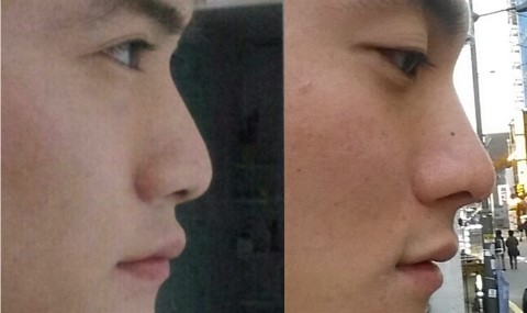  코끝 하이코 , 비순각필러 후기 (사진有)