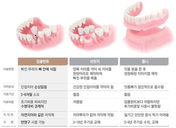 운정치과의원, 치아를 대신하는 '임플란트, 틀니, 브릿지' 차이점은?