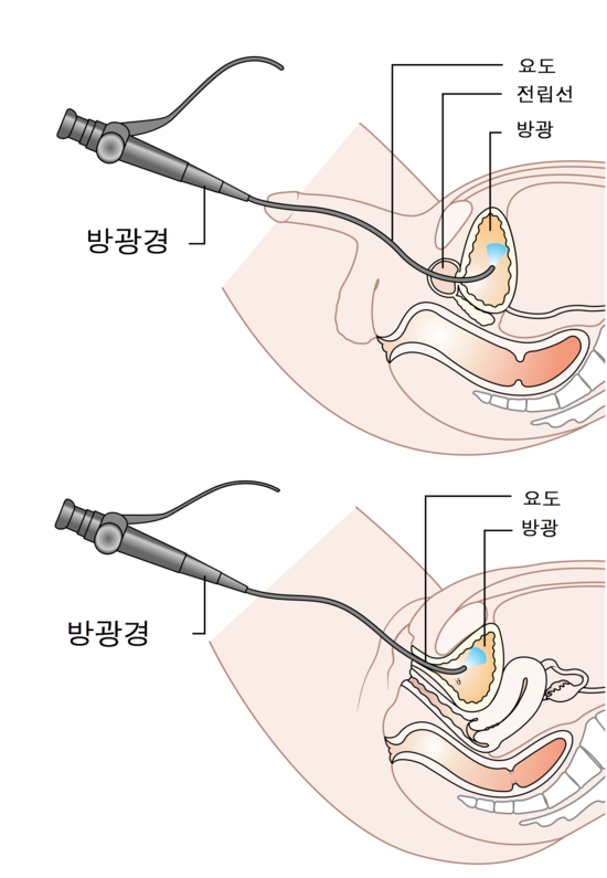 성기 사마귀, 남성 요도 불쾌감, 난경검사 필요