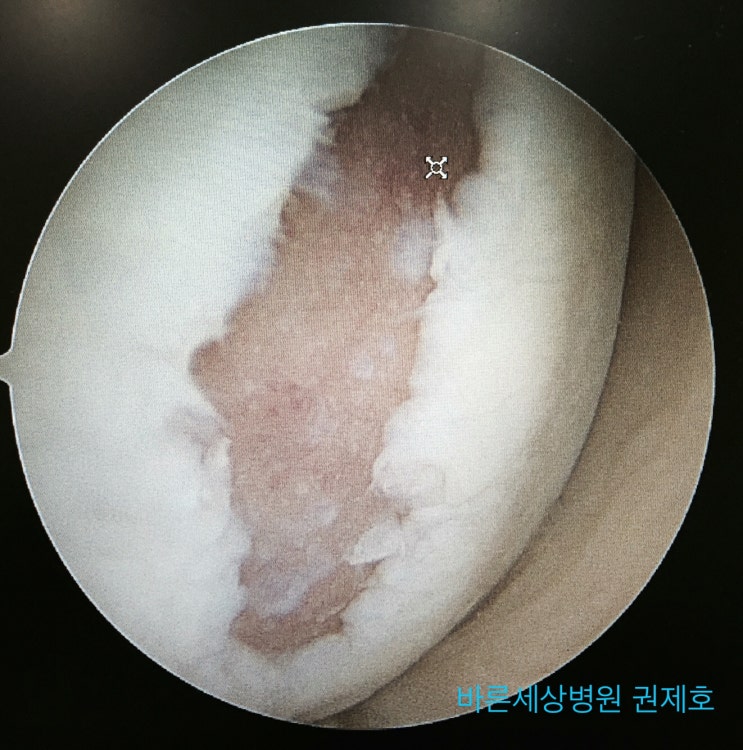 관절경을 이용한 미세천공술 을 이용한 무릎연골재생 방법 서울바른세상병원 권제호