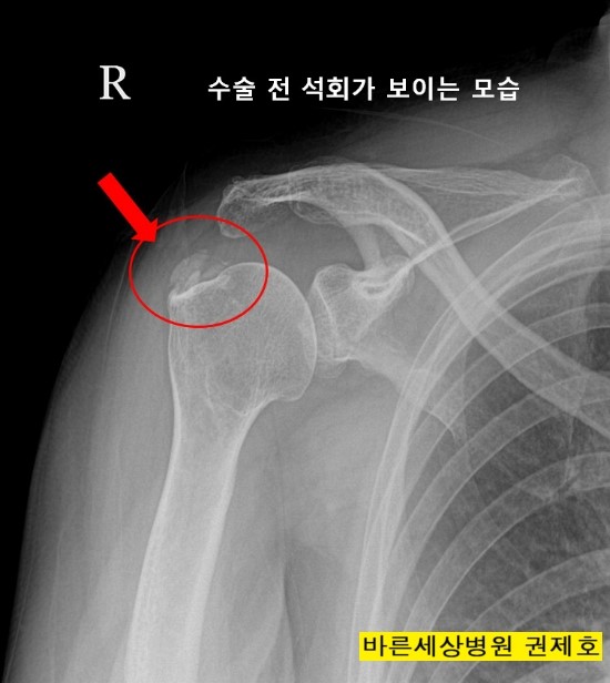 오른쪽 어깨 석회성건염 의 치료 서울 바른세상병원 권제호
