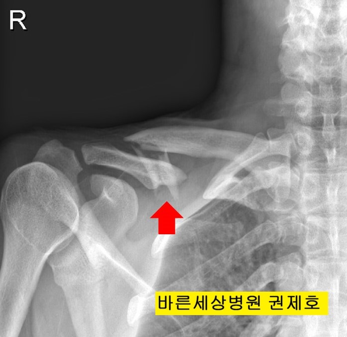  쇄골 분쇄 골절 수술 서울 바른세상병원 권제호