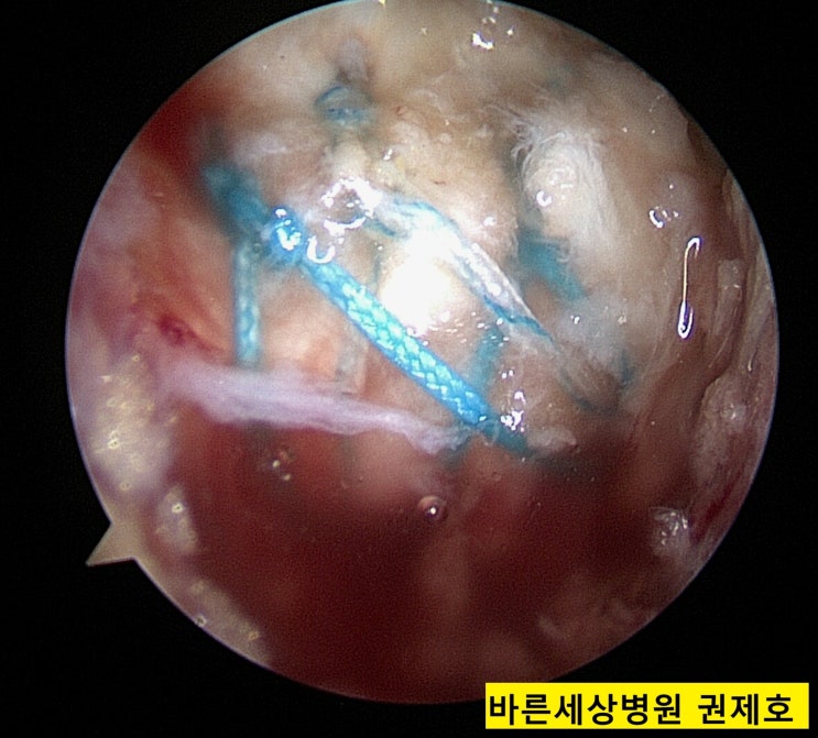  회전근개파열 에 대한 관절경적 이중봉합술 제이본정형외과 권제호