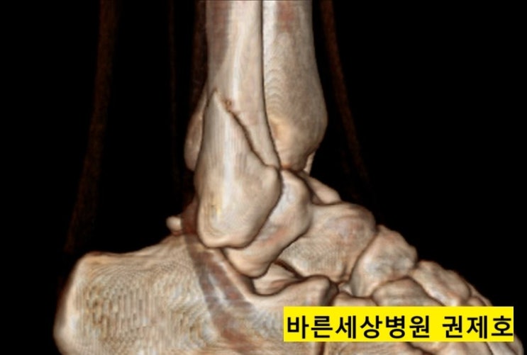 운동중 발목 접질렀을 때 생긴 발목 골절 수술 방법에 대해 / 서울바른세상병원 권제호