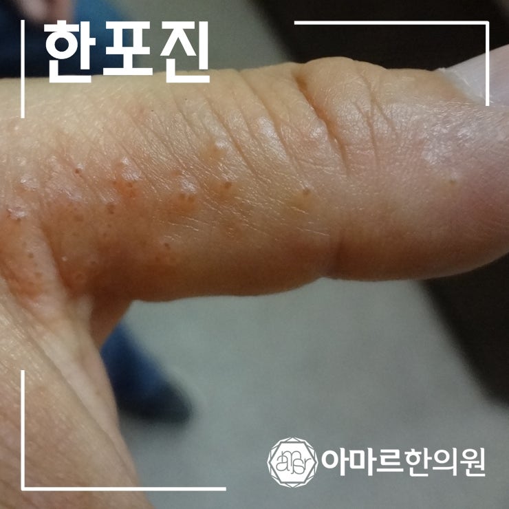손가락 습진의 경우 개선된 주요 사례만 정리했습니다. 9