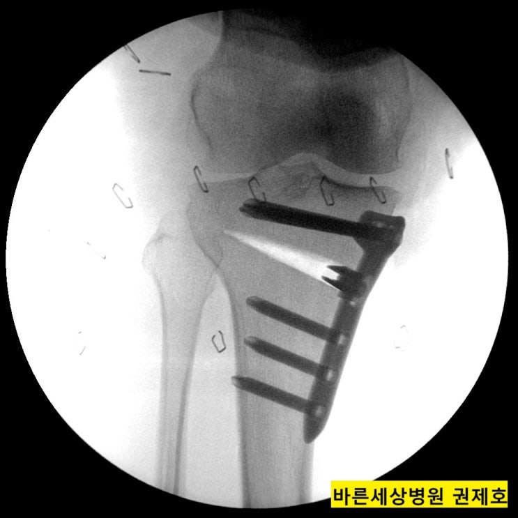 근위경골절골술, 줄기세포 연골재생술, 연골판 절제술 / 바른세상병원 권제호
