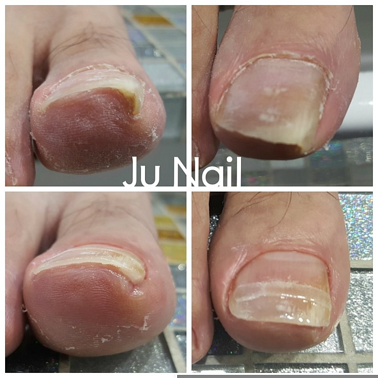 분당용인수지보정죽전네일샵/주네일/파고드는발톱 교정 분당용인수지보정죽전네일샵/주네일/파고드는발톱 교정