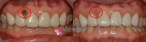  잇몸이 남들보다 까매요~(잇몸미백편)