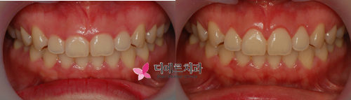 웃을때 잇몸이 많이 보여요~(거미스마일,잇몸성형편)