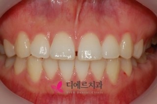 서면부분교정-빈틈없는 치아 만들기