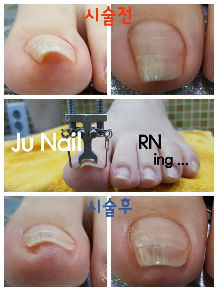 분당용인수지보정죽전네일샵/주네일/내향성발톱교정 분당용인수지보정죽전네일샵/주네일/내향성발톱교정