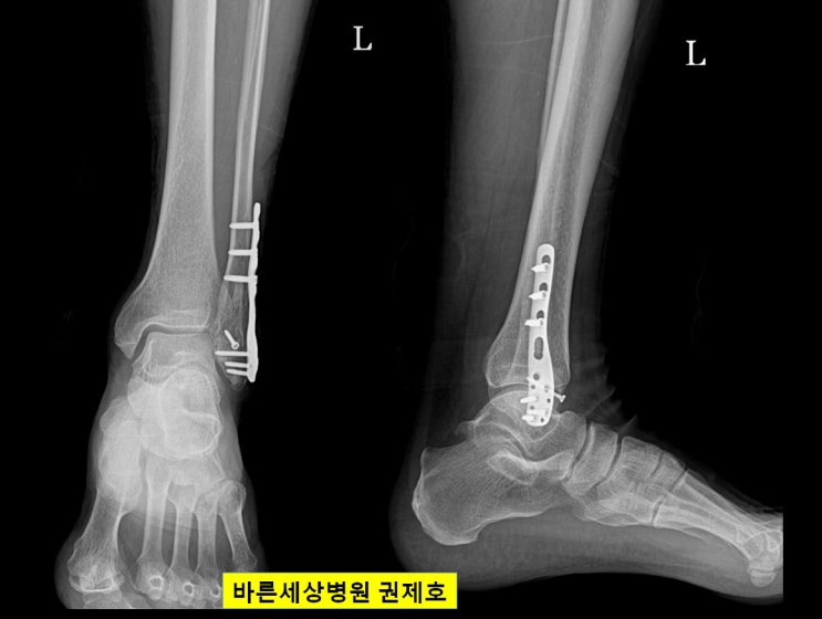  겨울철 하산길에서 미끄러지면서 '뚝', 발목 골절 수술 방법에 대해 / 서울바른세상병원 권제호