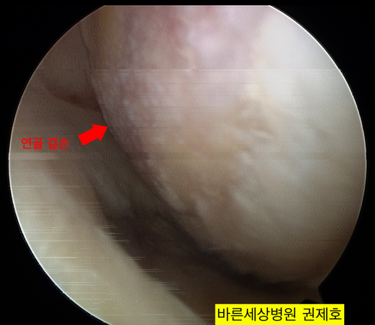  무릎 근위경골절골술, 무릎 연골재생술, 무릎 연골판 파열, 무릎 휜다리 수술의 예 / 서울바른세상병원 권제호