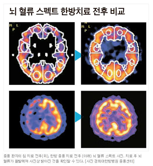 [스크랩] 뇌졸중(중풍) 후유증 한방 치료로 개선