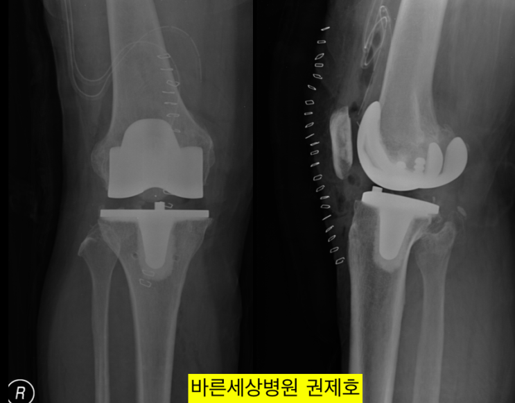 무릎인공관절수술 후 재활 및 활동 / 제이본정형외과 권제호
