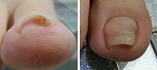 분당용인수지보정죽전네일샵/주네일/내향성(파고드는)발톱 분당용인수지보정죽전네일샵/주네일/내향성(파고드는)발톱