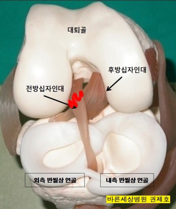 무릎통증을 유발하는 무릎질환 제이본정형외과 JBone 권제호