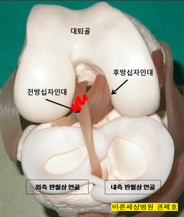  무릎통증을 유발하는 무릎질환 제이본정형외과 JBone 권제호