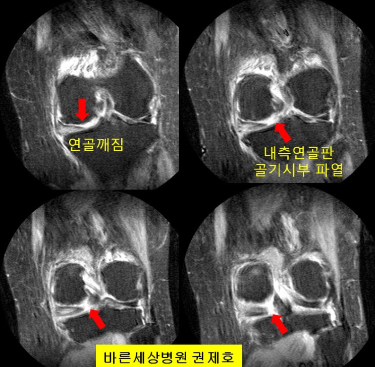 관절경적 연골판절제술, 미세천공술 및 근위경골절골술(휜다리교정) / 바른세상병원 권제호