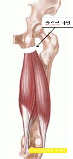  햄스트링 근육 손상의 치료 및 회복 hamstring 제이본정형외과 권제호