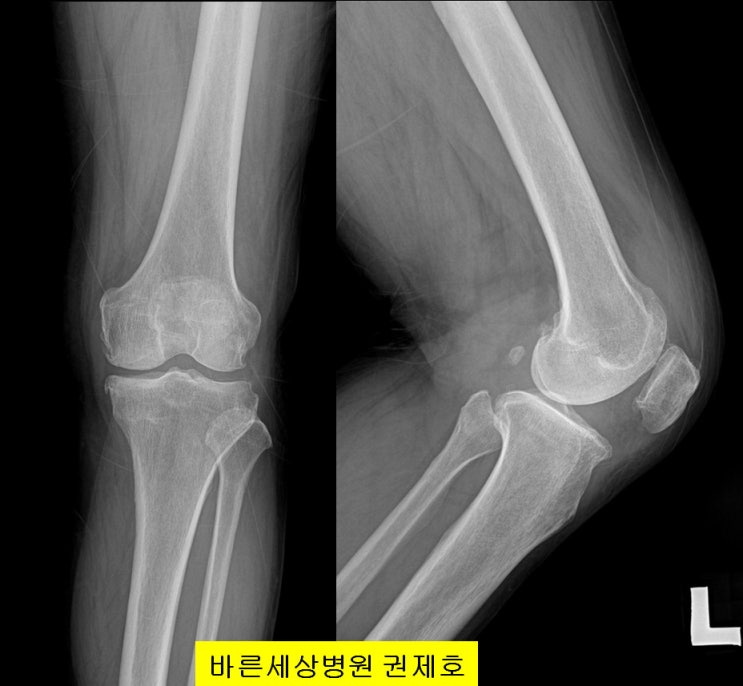 휜다리, 반월상연골판파열, 연골깨짐이 있는 환자의 치료 사례 / 바른세상병원 권제호