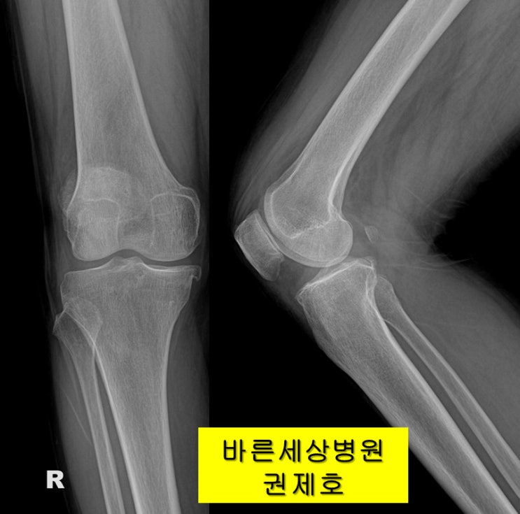 휜 다리 교정, 연골 결손, 반월상연골판 파열 수술적 치료 예 / 바른세상병원 권제호