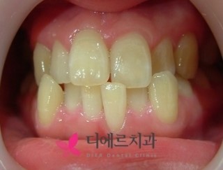 서면치아미백 치아미백은 치아를 약하게 한다?