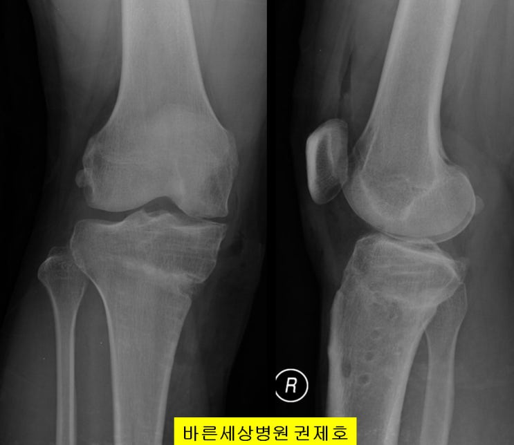  근위경골절골술, 줄기세포(카티스템)연골재생 2년 추시 결과 / 서울 바른세상병원 권제호