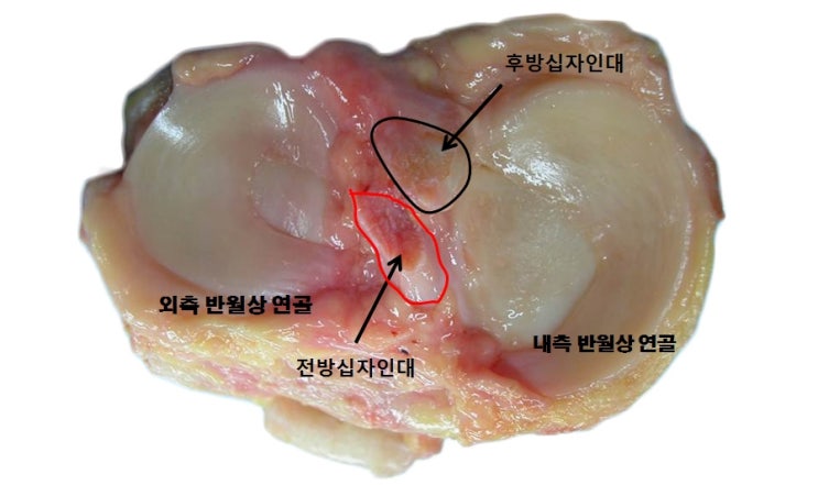  반월상연골판파열 의 모양에 따른 분류는? 염창동 제이본 정형외과 권제호