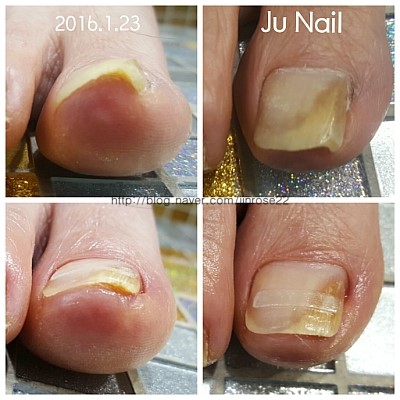 분당용인수지보정죽전네일샵/주네일/내향성(파고드는)발톱교정 전후 분당용인수지보정죽전네일샵/주네일/내향성(파고드는)발톱교정 전후