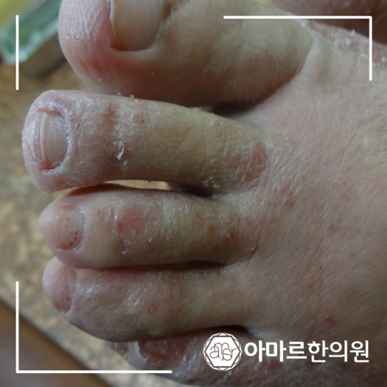 발 습진 - 발진, 가려움증 해결! ! 6