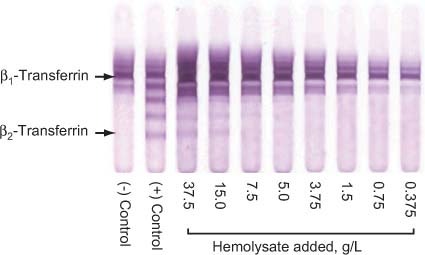 Beta 2 Transferrin : 네이버 블로그