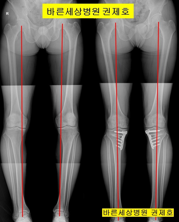 무릎 관절염의 수술적 치료 방법 / 제이본정형외과 권제호