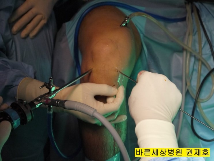 무릎 관절경 수술 (관절내시경)에 대한 개요 제이본정형외과 관절 권제호