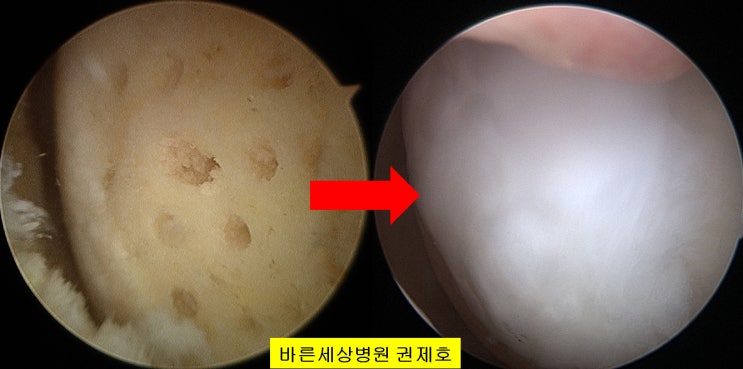 근위경골절골술 연골깨짐 2년의 결과 관절경 연골재생 및 휜다리교정수술  서울 바른세상병원 권제호