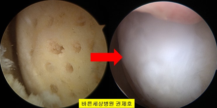  근위경골절골술 연골깨짐 2년의 결과 관절경 연골재생 및 휜다리교정수술  서울 바른세상병원 권제호
