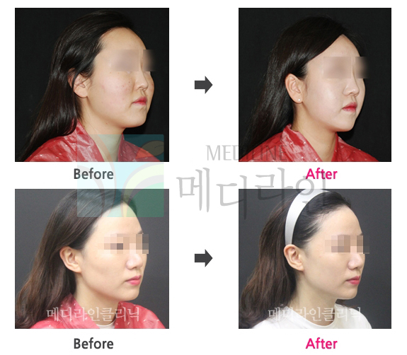 광대축소술 후기와 노하우를 확인해보세요