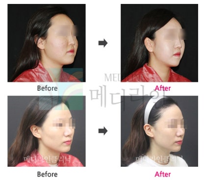 광대주사후기 광대주사후기