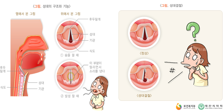 목이 쉬었을때 성대결절 증상일까? - 서비스포피 목이 쉬었을때 성대결절 증상일까? - 서비스포피