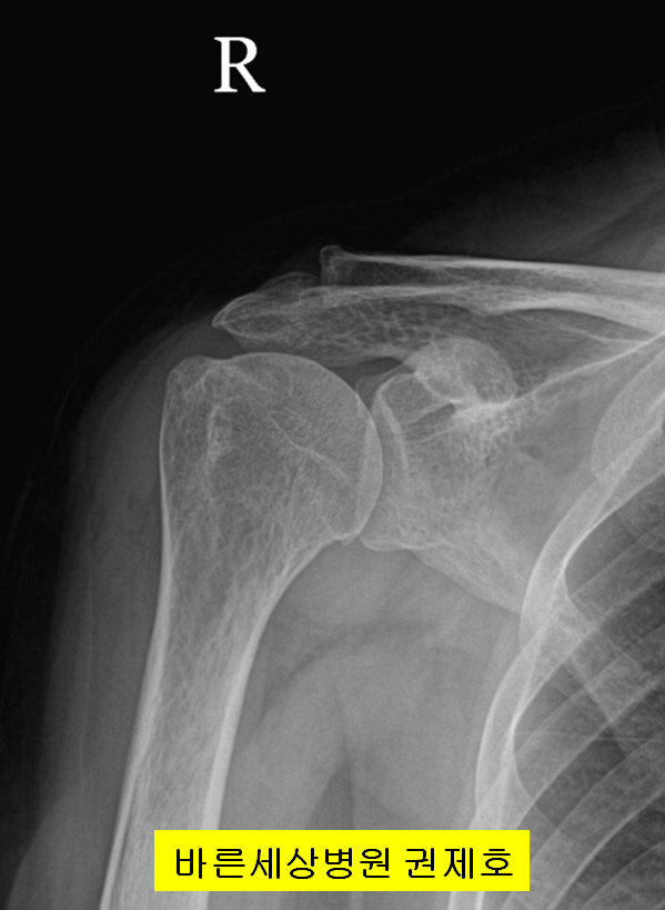 어깨 회전근개 재파열된 경우 시행하는 관절경 회전근개 이중 봉합술 제이본정형외과 권제호