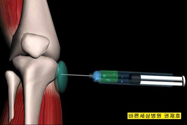  무릎의 거위발 점액낭염이란? / 서울바른세상병원 권제호
