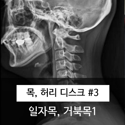   일자목, 거북목, 목디스크 관련 근육.