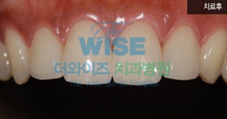 앞니 레진의 치료 방법과 치료 후 부작용이 생기는 원인은? 2