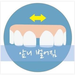 앞니 레진의 치료 방법과 치료 후 부작용이 생기는 원인은? 6
