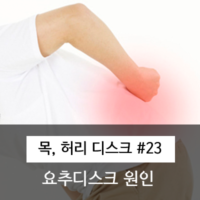  허리 디스크의 원인과 유발요인.