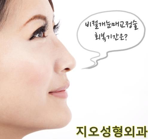 비절개눈매교정술 회복기간이 궁금해?